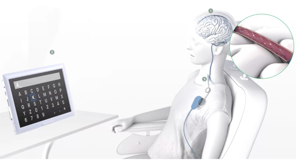 Stentrode: chip cerebral já permite controlar aparelhos com a mente ...